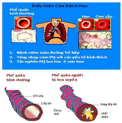 biểu hiện của bệnh hen